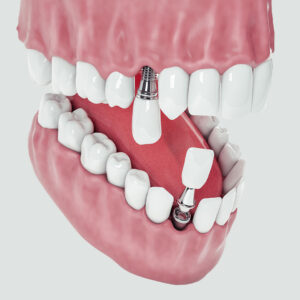 dental implants turkey antalya